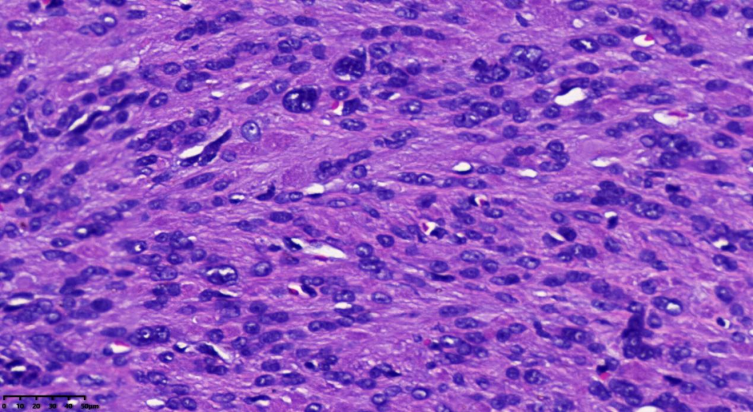 fh染色是什么意思病例分享 ｜ 延胡索酸水合酶（FH）缺陷型子宫平滑肌瘤_https://www.jmylbn.com_新闻资讯_第6张