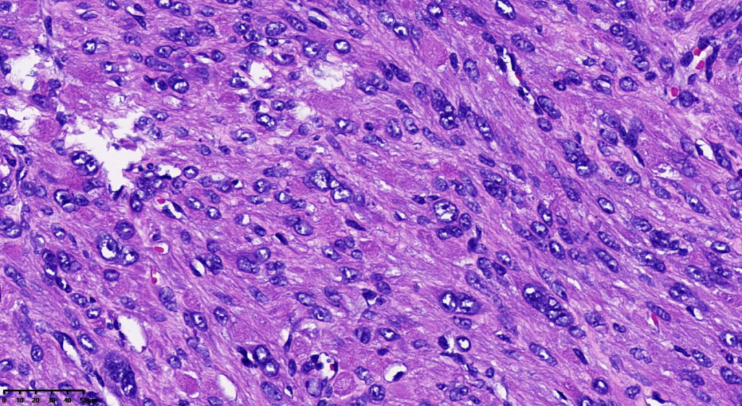 fh染色是什么意思病例分享 ｜ 延胡索酸水合酶（FH）缺陷型子宫平滑肌瘤_https://www.jmylbn.com_新闻资讯_第4张