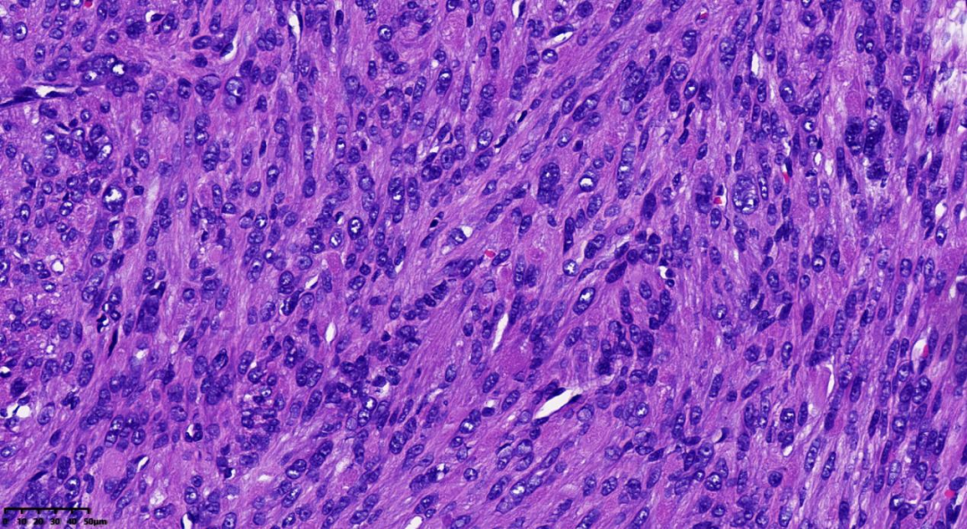 fh染色是什么意思病例分享 ｜ 延胡索酸水合酶（FH）缺陷型子宫平滑肌瘤_https://www.jmylbn.com_新闻资讯_第5张