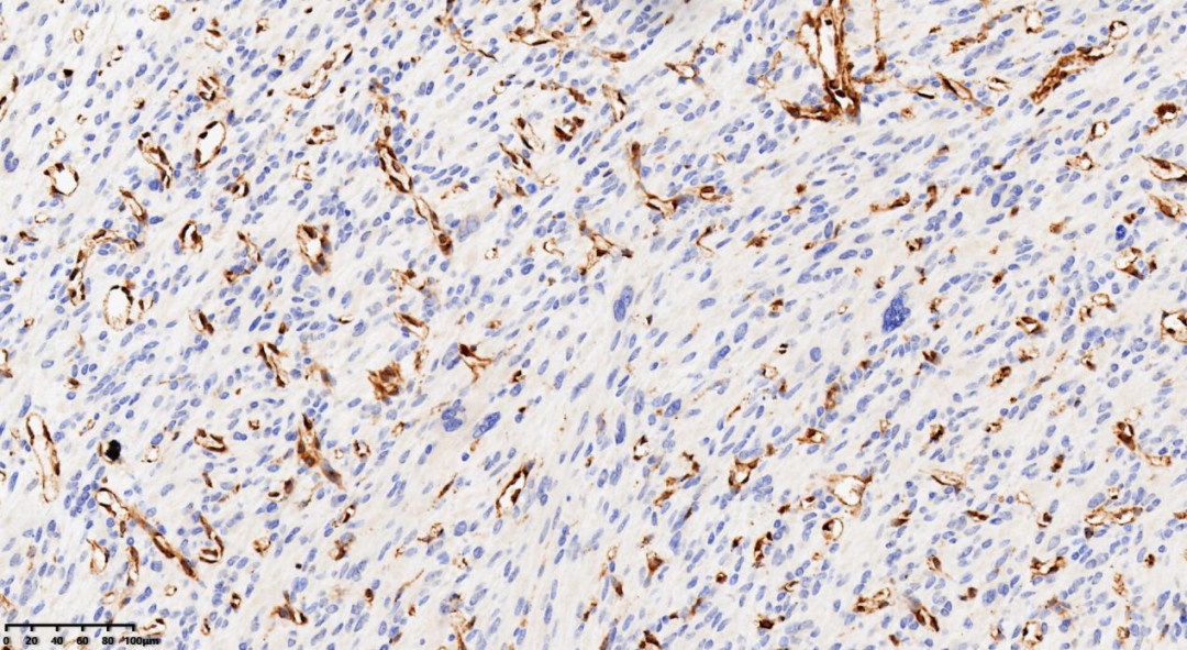 fh染色是什么意思病例分享 ｜ 延胡索酸水合酶（FH）缺陷型子宫平滑肌瘤_https://www.jmylbn.com_新闻资讯_第8张