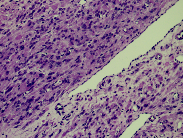 fh染色是什么意思病例分享 ｜ 延胡索酸水合酶（FH）缺陷型子宫平滑肌瘤_https://www.jmylbn.com_新闻资讯_第7张