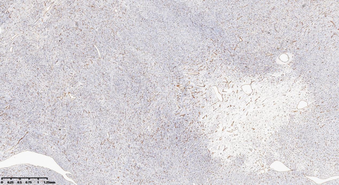 fh染色是什么意思病例分享 ｜ 延胡索酸水合酶（FH）缺陷型子宫平滑肌瘤_https://www.jmylbn.com_新闻资讯_第11张