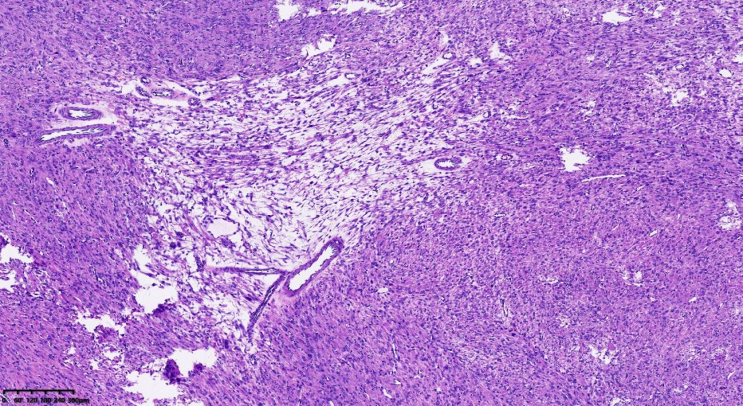 fh染色是什么意思病例分享 ｜ 延胡索酸水合酶（FH）缺陷型子宫平滑肌瘤_https://www.jmylbn.com_新闻资讯_第3张