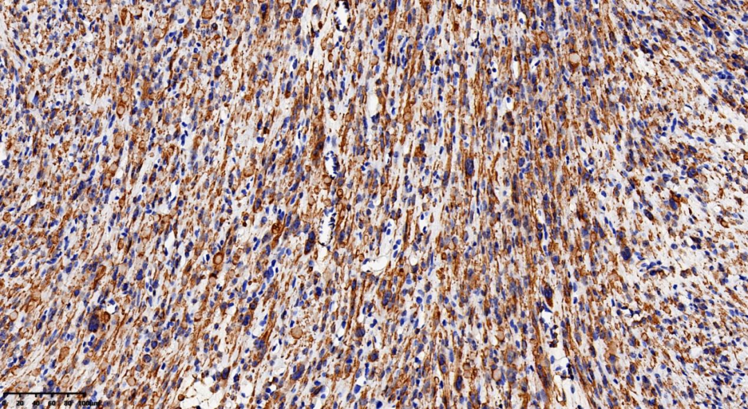 fh染色是什么意思病例分享 ｜ 延胡索酸水合酶（FH）缺陷型子宫平滑肌瘤_https://www.jmylbn.com_新闻资讯_第9张