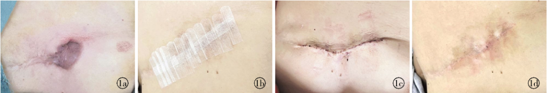 外科胶带怎么撕超减张缝合联合减张胶带在胸腹部增生性瘢痕中的临床应用效果_https://www.jmylbn.com_新闻资讯_第3张