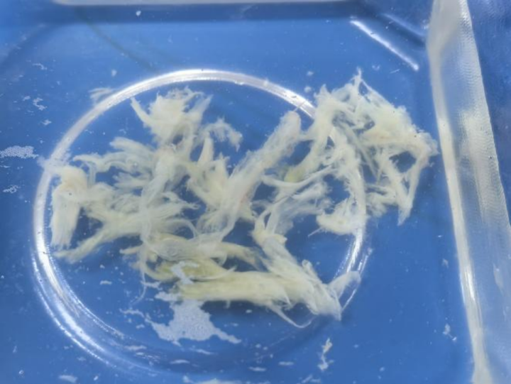 气管镜取出来的“痰栓”，图源：浙江之声