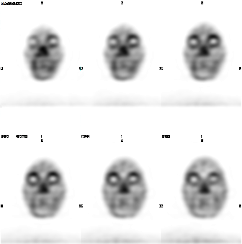 d-spect怎么检查【科普-健康知识】SPECT检查——眼眶显像_https://www.jmylbn.com_新闻资讯_第9张