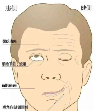 告别面部歪斜困扰 | 中山一院广西医院脉冲射频技术为面瘫患者带来新希望