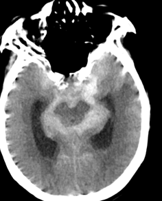 69岁老人心脏骤停+重症脑动脉瘤 | 中山一院广西医院神经外科联合多学科全力抢救转危为安