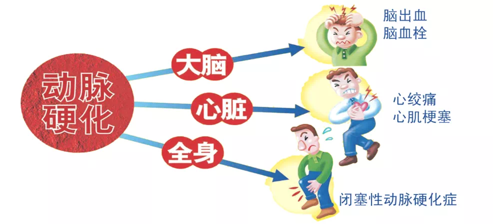 动脉硬化检测检查什么【科普】健康体检需要做动脉硬化检测吗？_https://www.jmylbn.com_新闻资讯_第14张
