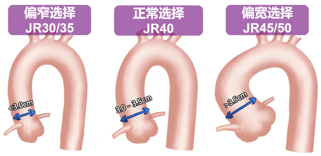 介入怎么进导管陈勇：介入秘籍——指引导管的选择及操作要点_https://www.jmylbn.com_新闻资讯_第8张
