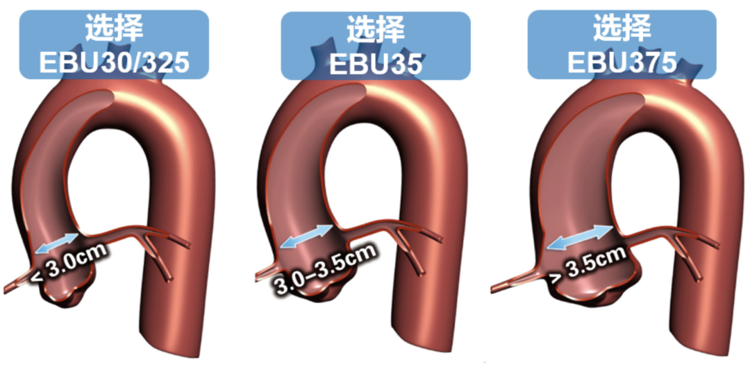 介入怎么进导管陈勇：介入秘籍——指引导管的选择及操作要点_https://www.jmylbn.com_新闻资讯_第6张