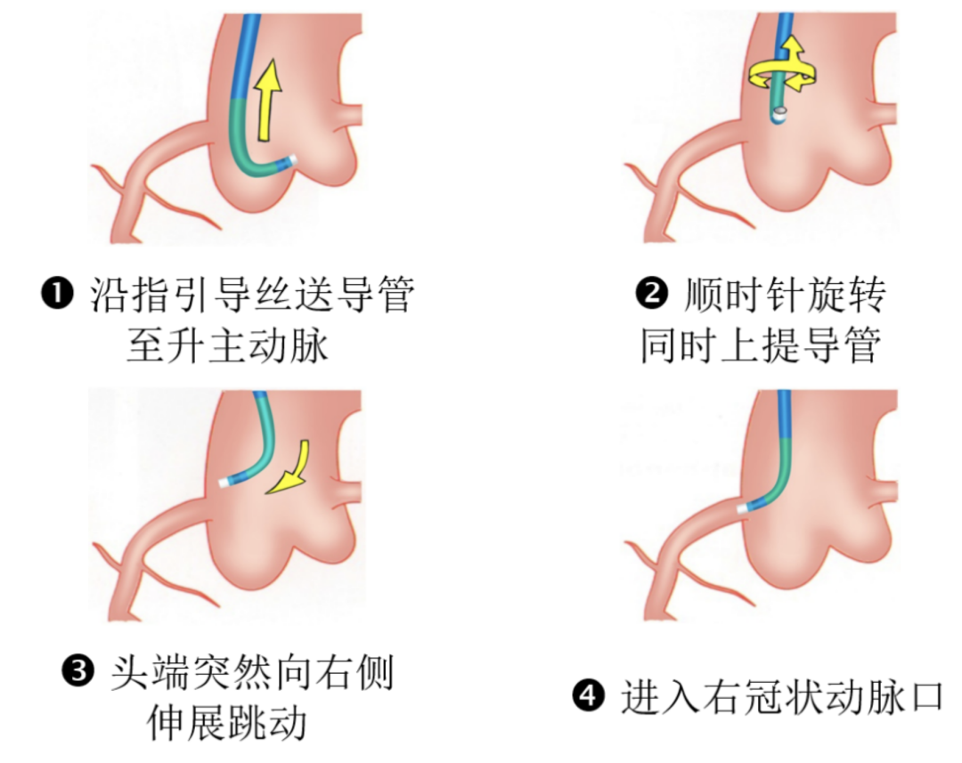 介入怎么进导管陈勇：介入秘籍——指引导管的选择及操作要点_https://www.jmylbn.com_新闻资讯_第9张