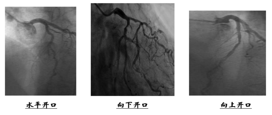 介入怎么进导管陈勇：介入秘籍——指引导管的选择及操作要点_https://www.jmylbn.com_新闻资讯_第5张