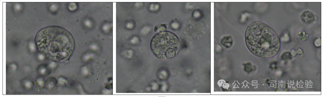 尿沉渣仪器怎么使用尿液-吞噬细胞（仪器辅助诊断）_https://www.jmylbn.com_新闻资讯_第8张