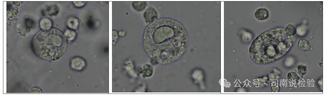 尿沉渣仪器怎么使用尿液-吞噬细胞（仪器辅助诊断）_https://www.jmylbn.com_新闻资讯_第6张