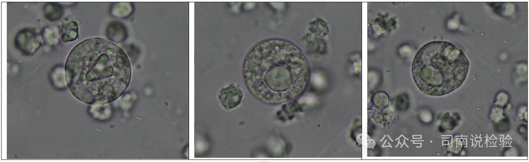 尿沉渣仪器怎么使用尿液-吞噬细胞（仪器辅助诊断）_https://www.jmylbn.com_新闻资讯_第7张