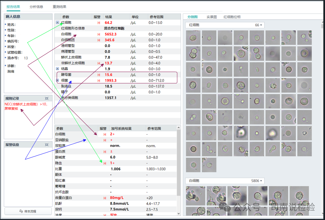尿沉渣仪器怎么使用尿液-吞噬细胞（仪器辅助诊断）_https://www.jmylbn.com_新闻资讯_第2张