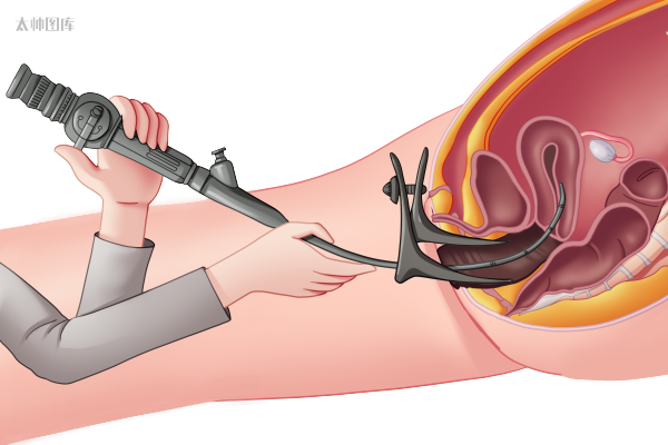 宫颈活检取样怎么取异常宫颈组织取样活检过程丨医学英语视听学习_https://www.jmylbn.com_新闻资讯_第1张