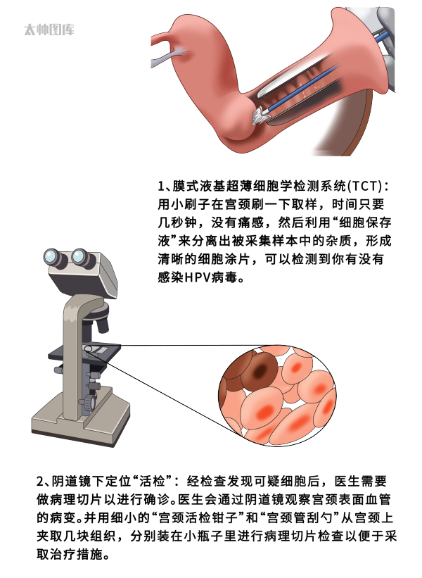 宫颈活检取样怎么取异常宫颈组织取样活检过程丨医学英语视听学习_https://www.jmylbn.com_新闻资讯_第3张