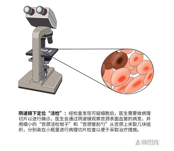 宫颈活检取样怎么取异常宫颈组织取样活检过程丨医学英语视听学习_https://www.jmylbn.com_新闻资讯_第2张