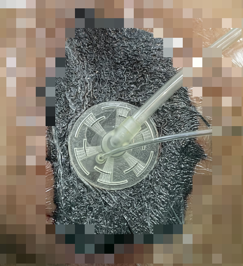 为什么负压引流“露骨”压疮碗口大，“负压”引流终治愈！_https://www.jmylbn.com_新闻资讯_第3张