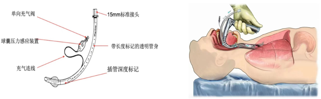 气管插管导丝有什么用健康科普 ｜ 气管插管的那些事儿_https://www.jmylbn.com_新闻资讯_第2张