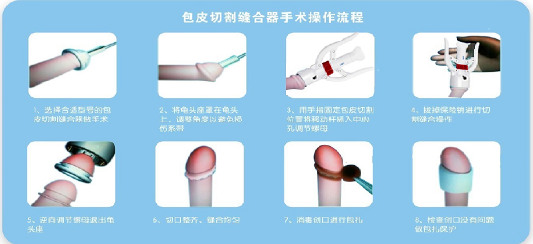 手术吻合器什么扎堆手术？为什么都选择用吻合器做包皮环切术_https://www.jmylbn.com_新闻资讯_第4张
