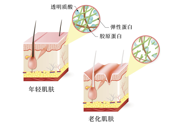 创面修复医用敷料怎么用学术分享｜重组胶原蛋白在炎症性皮肤病中的应用_https://www.jmylbn.com_新闻资讯_第5张