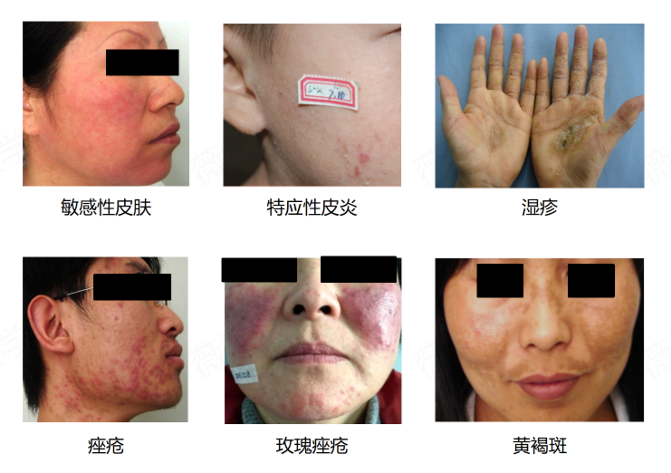 创面修复医用敷料怎么用学术分享｜重组胶原蛋白在炎症性皮肤病中的应用_https://www.jmylbn.com_新闻资讯_第2张