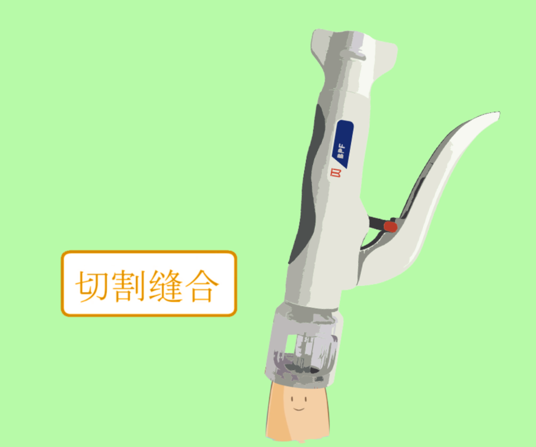 包皮吻合器是什么切包皮有新技术啦!我院开展“包皮环切吻合器”微创手术_https://www.jmylbn.com_新闻资讯_第2张