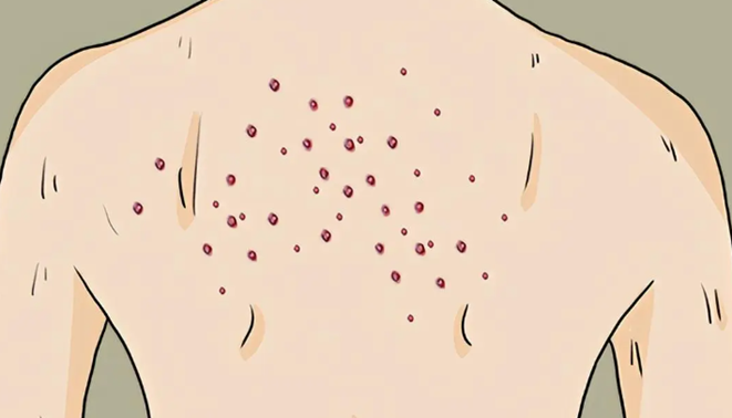 什么是马拉色菌毛囊炎