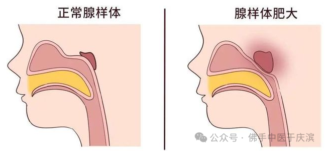于氏儿科讲腺样体肥大要忌口
