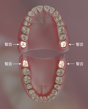 牙科骨凿怎么用嘴里那颗“智齿”到底要不要拔？纠结100次不如听牙科医生说一回_https://www.jmylbn.com_新闻资讯_第5张