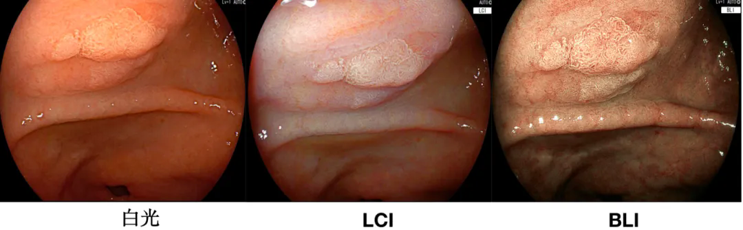 富士胃镜英文怎么写【重磅升级】长兴第二医院全新上线“肠胃健康侦察兵”—富士ELUXEO Lite6000电子肠胃镜，早癌筛查精准度再突破！_https://www.jmylbn.com_新闻资讯_第5张