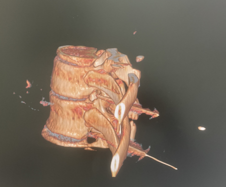 双极射频是什么疼痛科｜开展双极神经射频，为带状疱疹患者斩断 “痛根”_https://www.jmylbn.com_新闻资讯_第6张