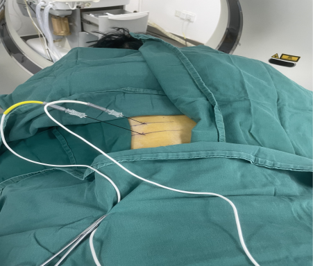 双极射频是什么疼痛科｜开展双极神经射频，为带状疱疹患者斩断 “痛根”_https://www.jmylbn.com_新闻资讯_第5张