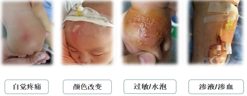 什么是安全留置针＂静＂享安全、＂针＂的实用，一起认识静脉留置针_https://www.jmylbn.com_新闻资讯_第9张