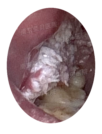 康复治疗激光怎么收费临床实录：夫妻尖锐湿疣康复案例（激光、药物治疗三次复发）_https://www.jmylbn.com_新闻资讯_第4张