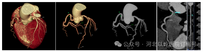 太行ct怎么样【硬核设备】河北以岭医院引进超高端 CT，开启精准医疗新篇章_https://www.jmylbn.com_新闻资讯_第11张