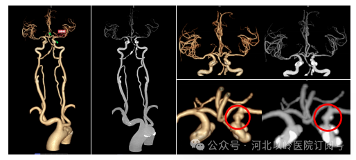 太行ct怎么样【硬核设备】河北以岭医院引进超高端 CT，开启精准医疗新篇章_https://www.jmylbn.com_新闻资讯_第12张