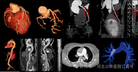 太行ct怎么样【硬核设备】河北以岭医院引进超高端 CT，开启精准医疗新篇章_https://www.jmylbn.com_新闻资讯_第9张