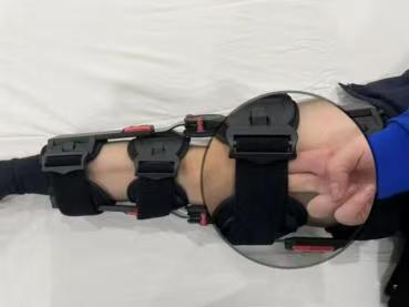 可调膝关节支具怎么用【科室风采】膝关节支具使用指南：从正确佩戴到智能康复—— 选对、戴好、勤维护，让康复事半功倍_https://www.jmylbn.com_新闻资讯_第6张