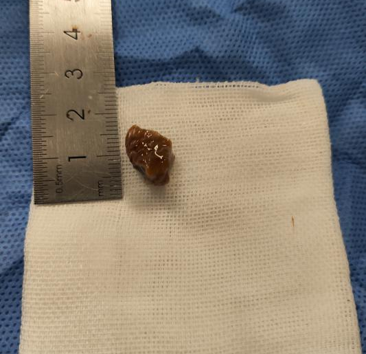 八旬老人“物”入“气”途 重医附属璧山医院呼吸科成功为其巧取异物