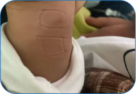 无痛皮试仪怎么用安顺市人民医院第一分院（关岭自治县人民医院）开展无痛皮试：为患儿成为就医体验的新选择_https://www.jmylbn.com_新闻资讯_第4张