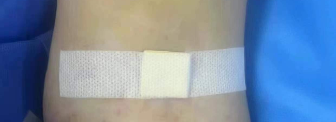 止血贴怎么贴内瘘止血新方法！你get到了吗？_https://www.jmylbn.com_新闻资讯_第12张