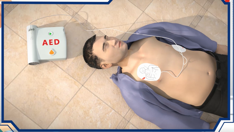 aed电极贴怎么贴使用AED时，电极片贴哪里才对？这堂“暑假安全课”细节满满！_https://www.jmylbn.com_新闻资讯_第5张