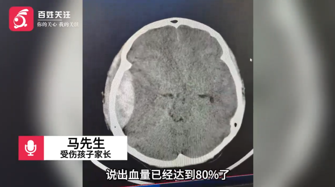 初一学生打球遭同学袭击致脑出血