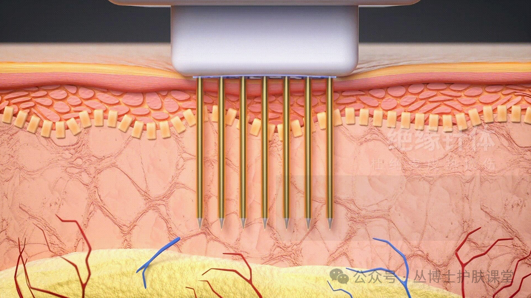 多极射频是什么《医用射频皮肤美容与治疗专家共识》解读（1）射频的分类与作用原理_https://www.jmylbn.com_新闻资讯_第10张