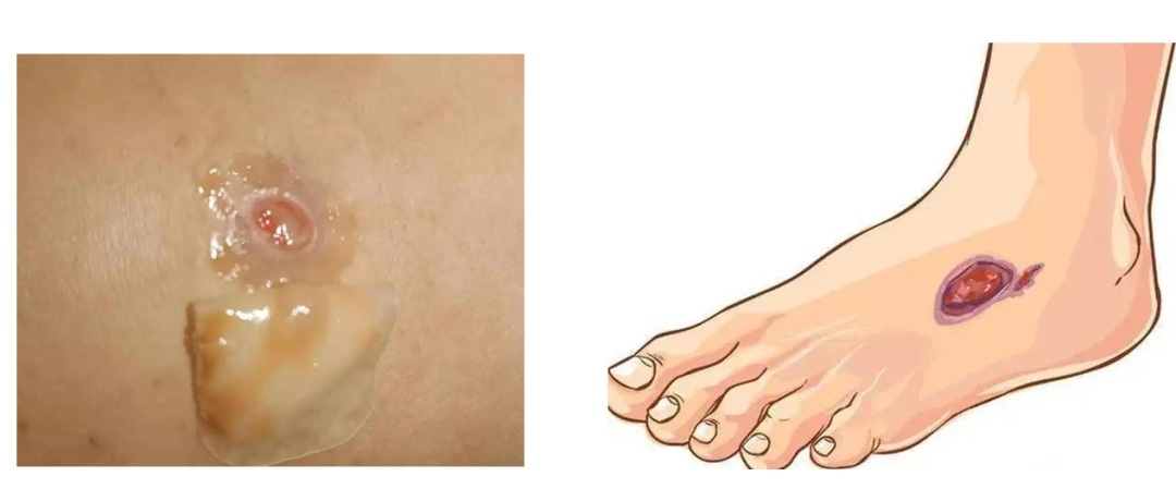 创面修复敷料怎么使用烂脸期总踩坑？皮肤科医生划重点：修护≠屏障修复≠创面修复！_https://www.jmylbn.com_新闻资讯_第15张